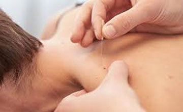 Dryneedling